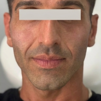 قبل از جوانسازی صورت
